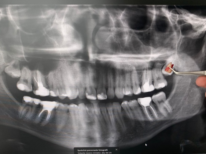 Bolesť zuba Nitra